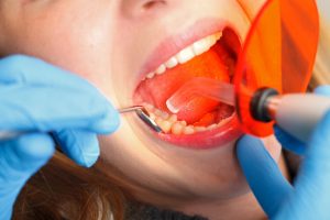 The Different Types of Dental Fillings