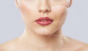 How Laser Skin Resurfacing Can Improve Your Skin's Texture and Tone